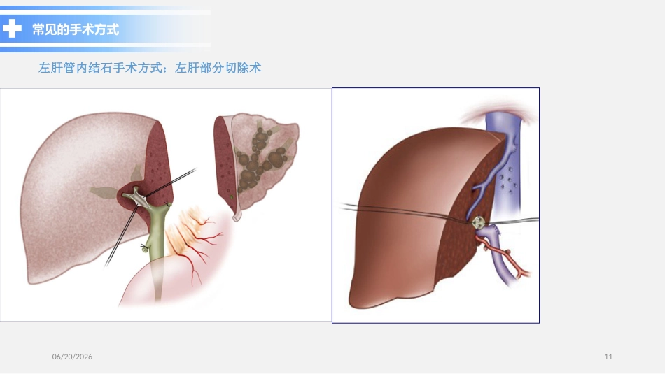 胆总管结石PPT参考课件_第11页
