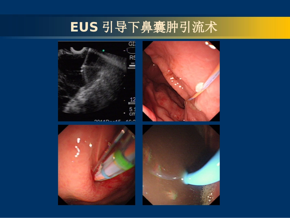EUS-FNA在消化系统疾病中的应用_第11页