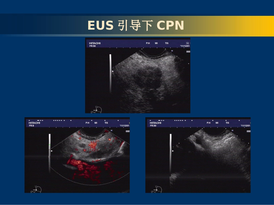 EUS-FNA在消化系统疾病中的应用_第12页