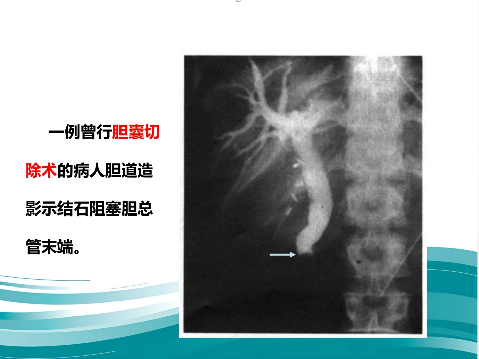 胆道系统疾病检查_第12页