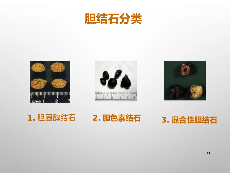 胆结石的诊治_第11页