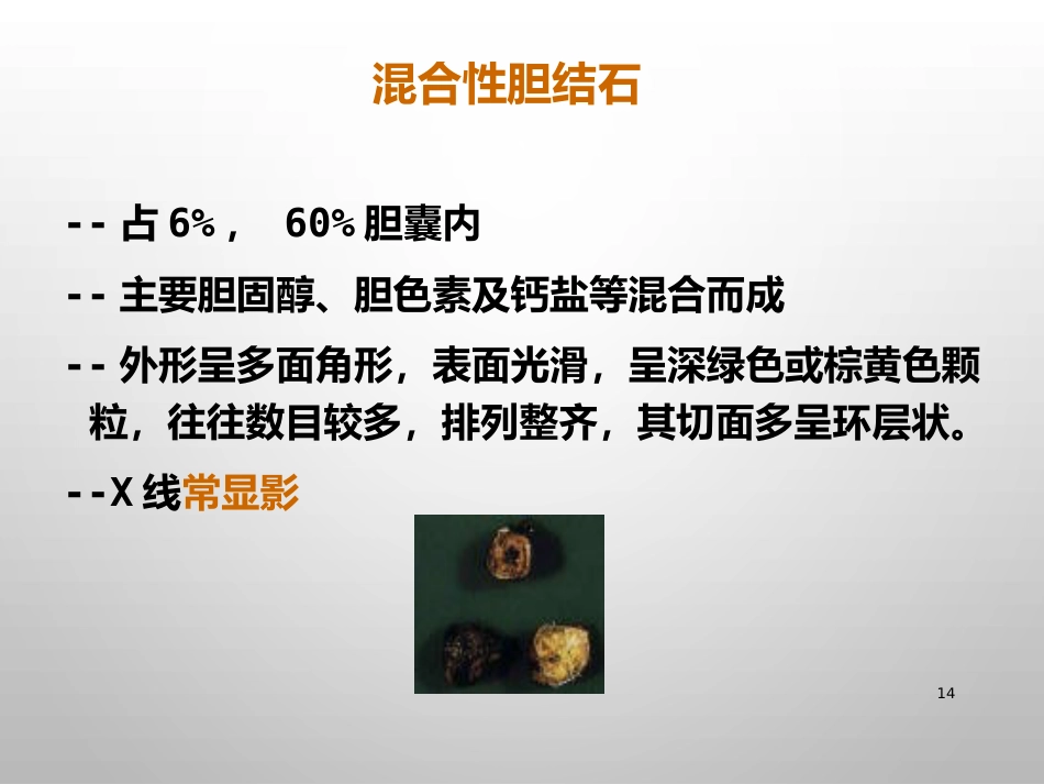 胆结石的诊治_第14页