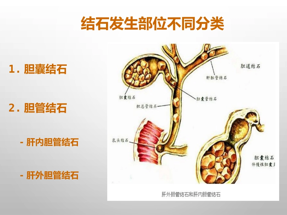 胆结石的诊治_第15页