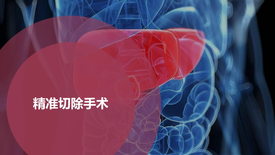 PPT案例-肝癌的精准治疗_第15页