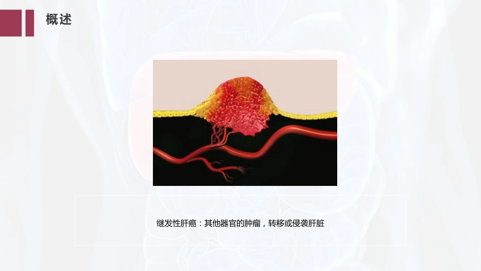 PPT案例-肝癌的精准治疗_第5页