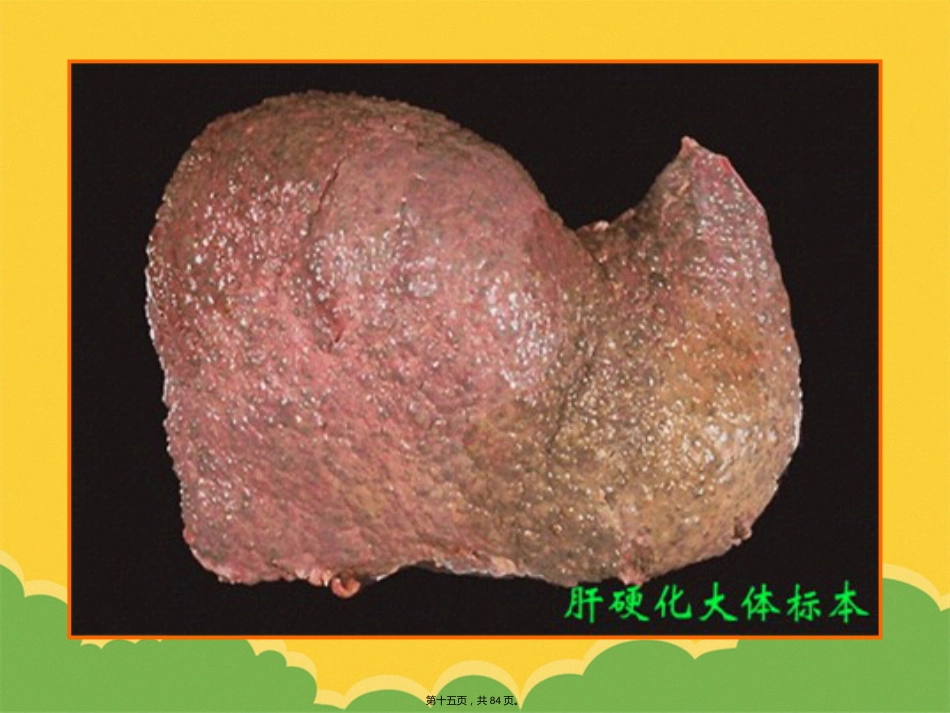 版肝硬化_第15页
