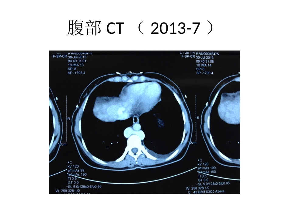 布加综合征肝癌_第3页