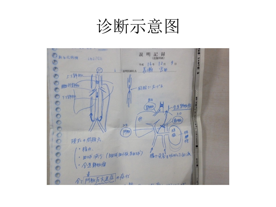 布加综合征肝癌_第8页