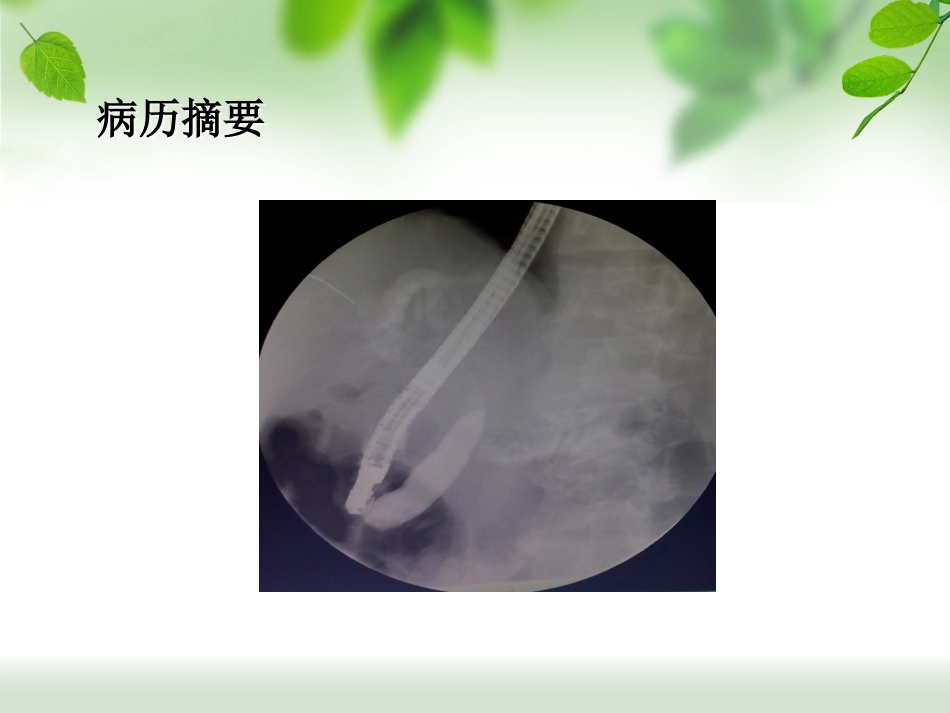 ERCP治疗胆总管结石_第12页