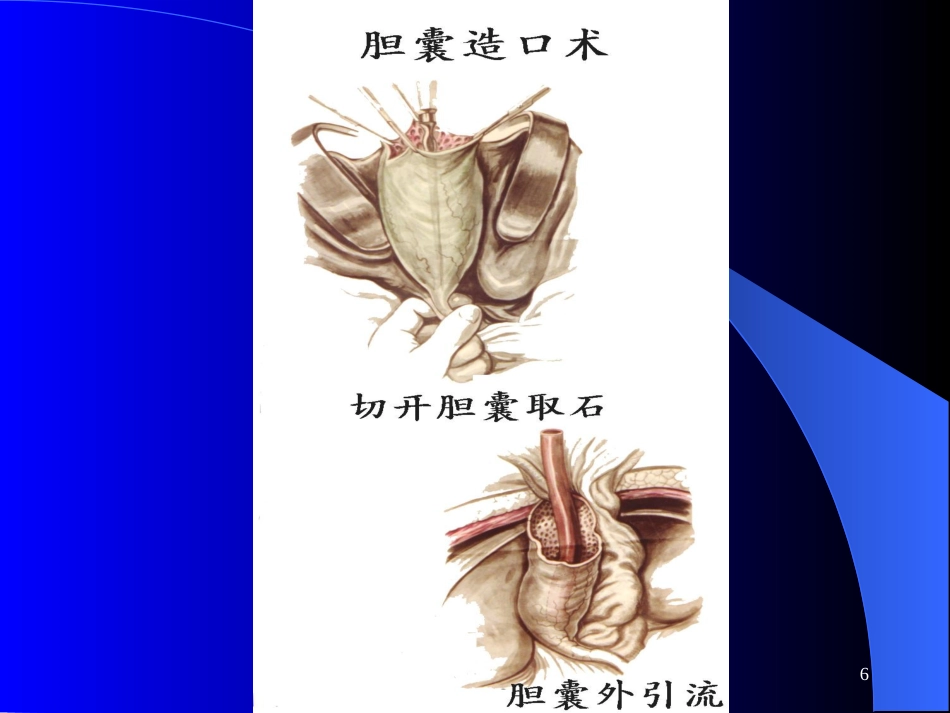 《肝内胆管结石》_第6页