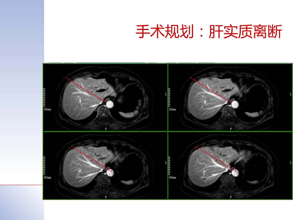 腹腔镜肝切除治疗肝内胆管结石典型病案_第10页