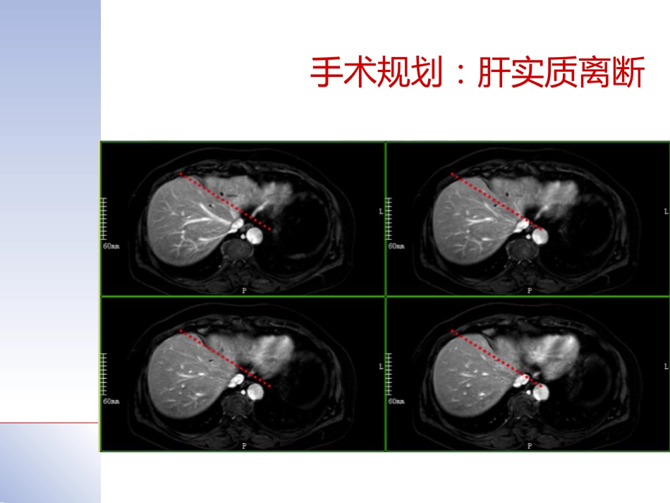 腹腔镜肝切除治疗肝内胆管结石典型病案_第11页