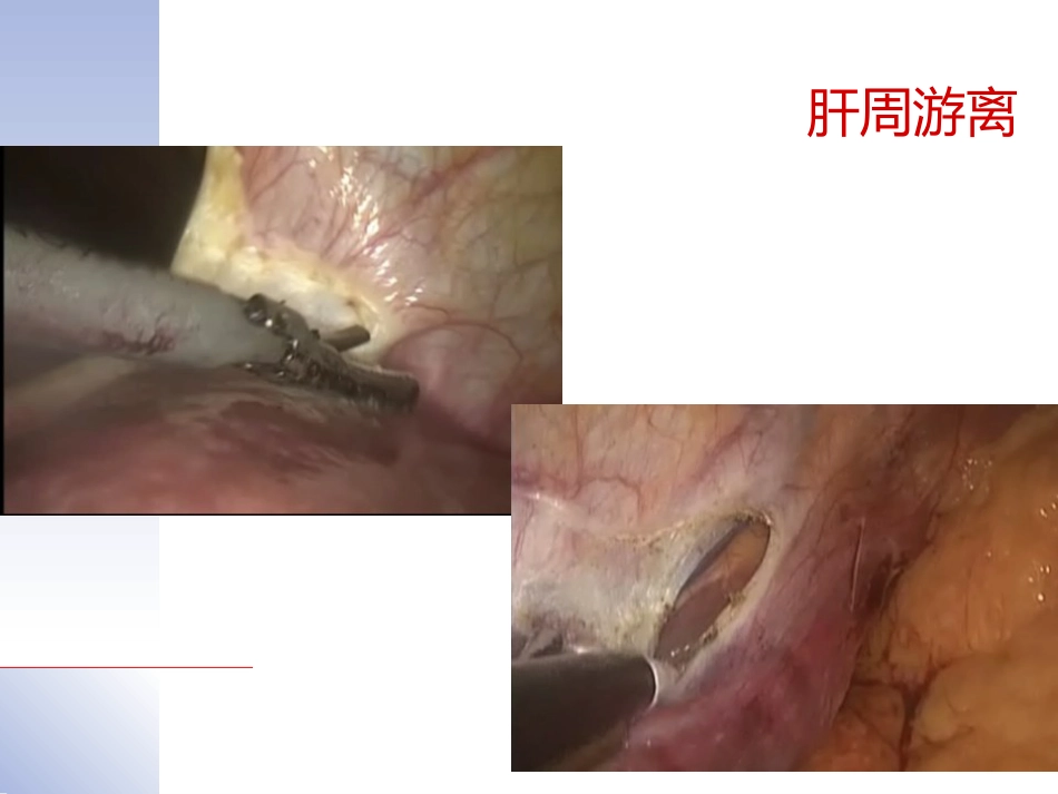 腹腔镜肝切除治疗肝内胆管结石典型病案_第13页