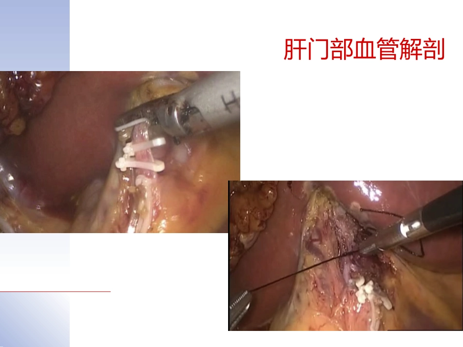 腹腔镜肝切除治疗肝内胆管结石典型病案_第14页