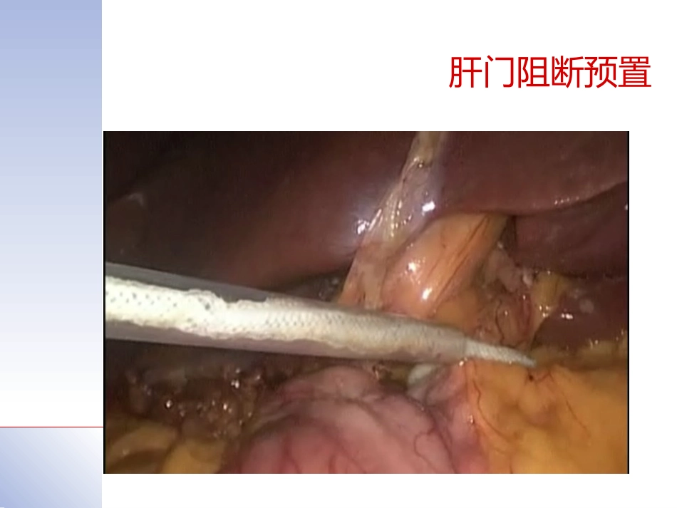 腹腔镜肝切除治疗肝内胆管结石典型病案_第15页