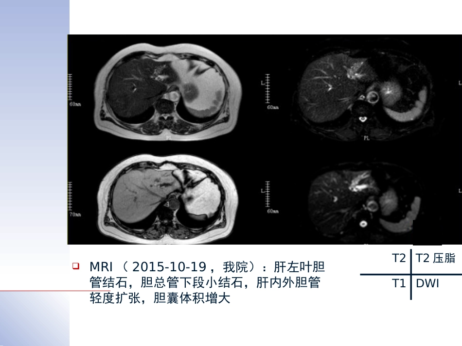 腹腔镜肝切除治疗肝内胆管结石典型病案_第3页