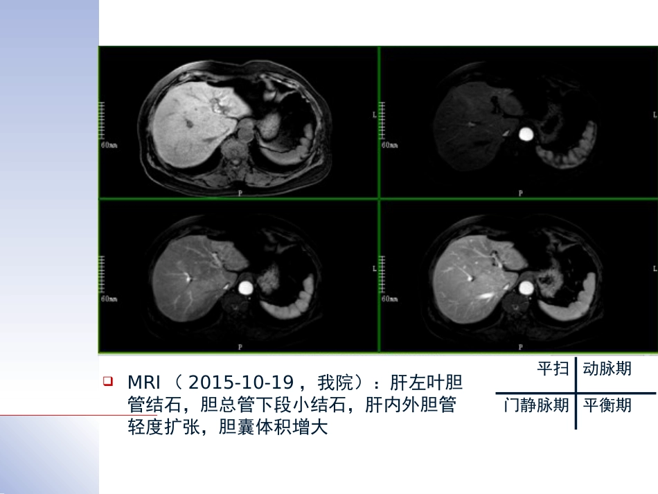 腹腔镜肝切除治疗肝内胆管结石典型病案_第4页