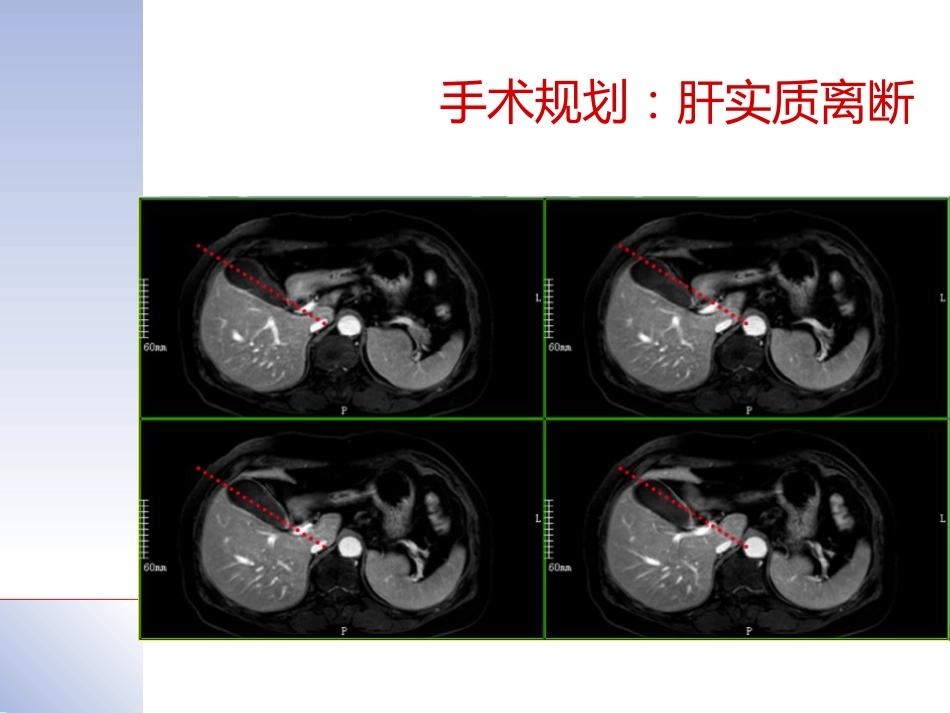 腹腔镜肝切除治疗肝内胆管结石典型病案_第6页