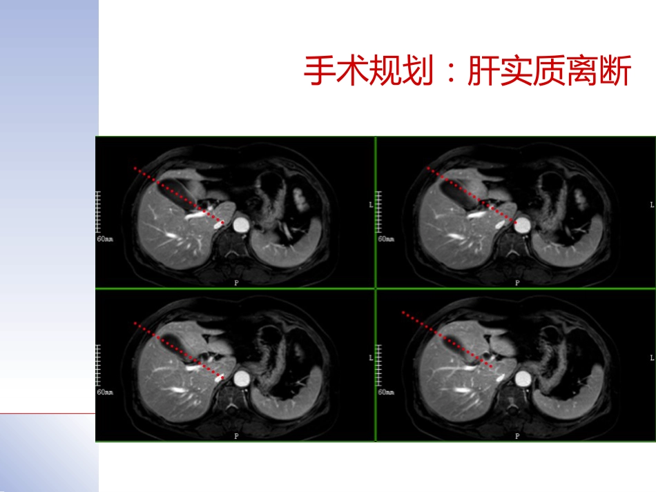 腹腔镜肝切除治疗肝内胆管结石典型病案_第7页