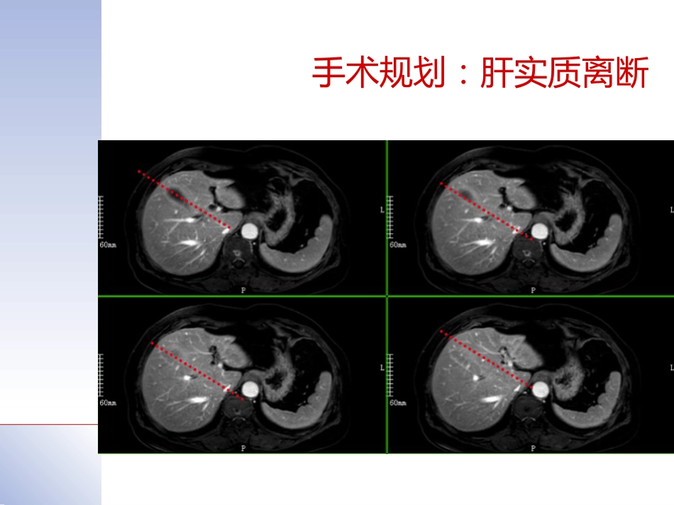 腹腔镜肝切除治疗肝内胆管结石典型病案_第8页