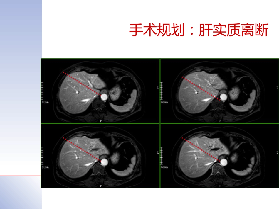 腹腔镜肝切除治疗肝内胆管结石典型病案_第9页