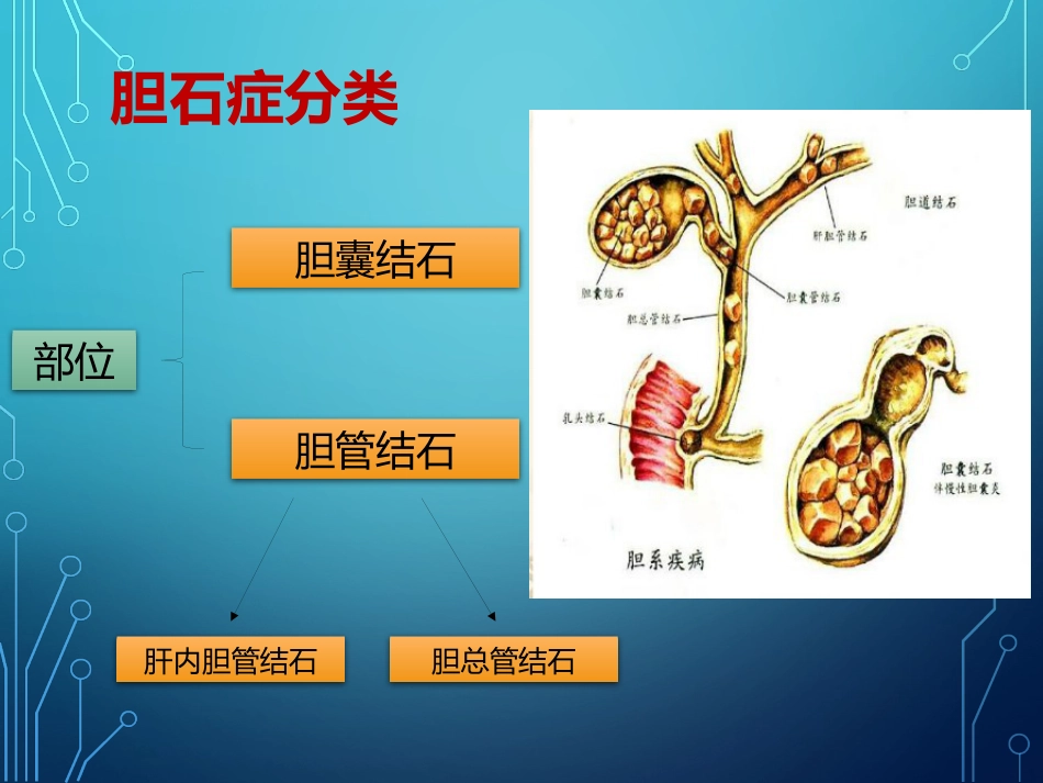 胆结石诊疗的新进展_第4页