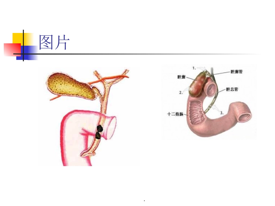胆囊结石并胆囊炎护理及饮食指导_第3页
