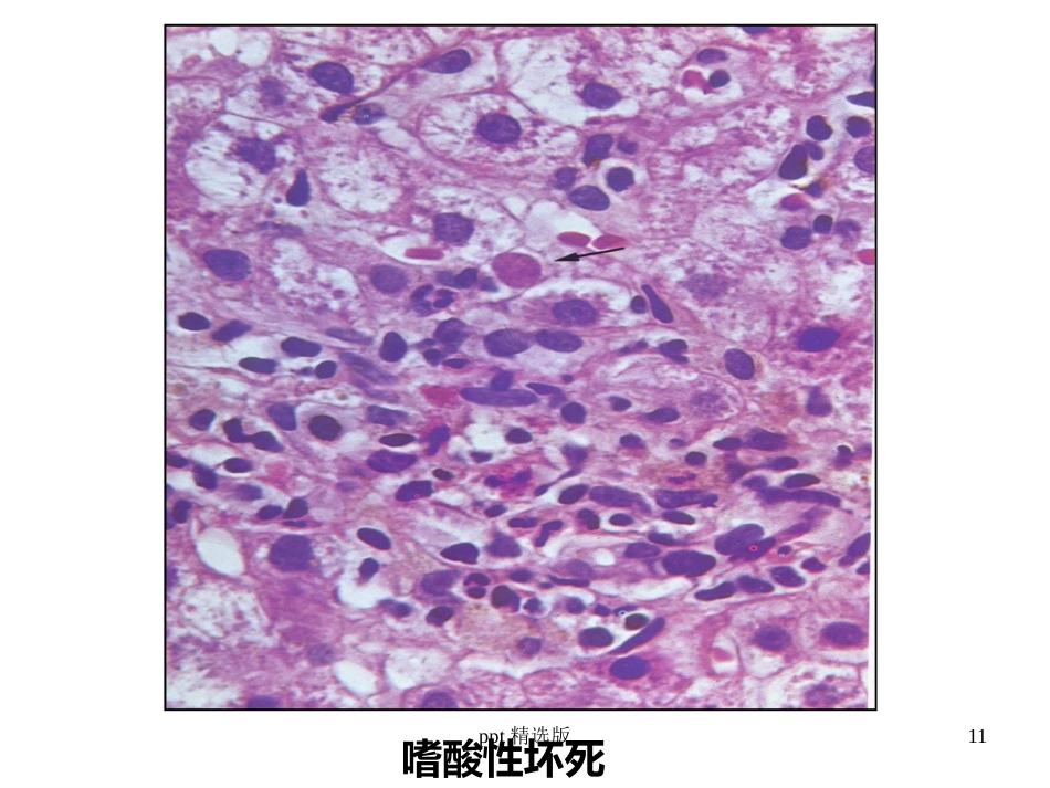 病毒性肝炎,肝硬化,肝癌ppt课件_第11页
