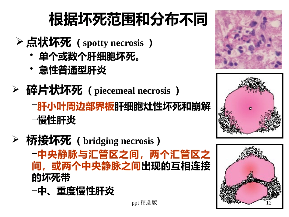 病毒性肝炎,肝硬化,肝癌ppt课件_第12页