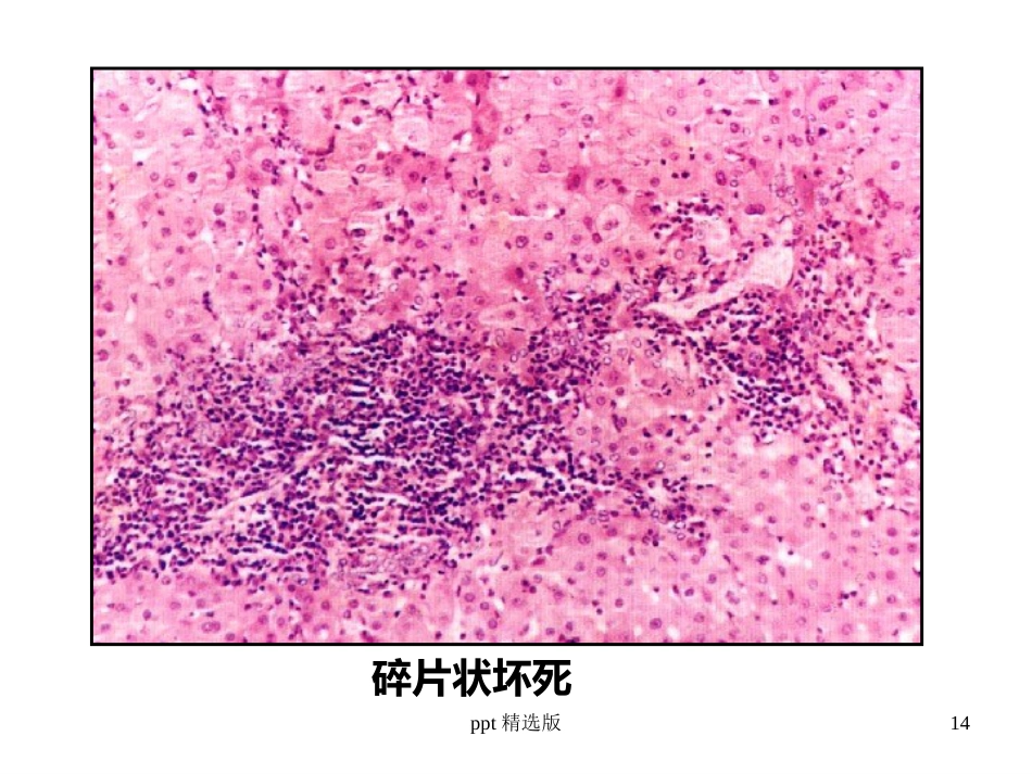 病毒性肝炎,肝硬化,肝癌ppt课件_第14页
