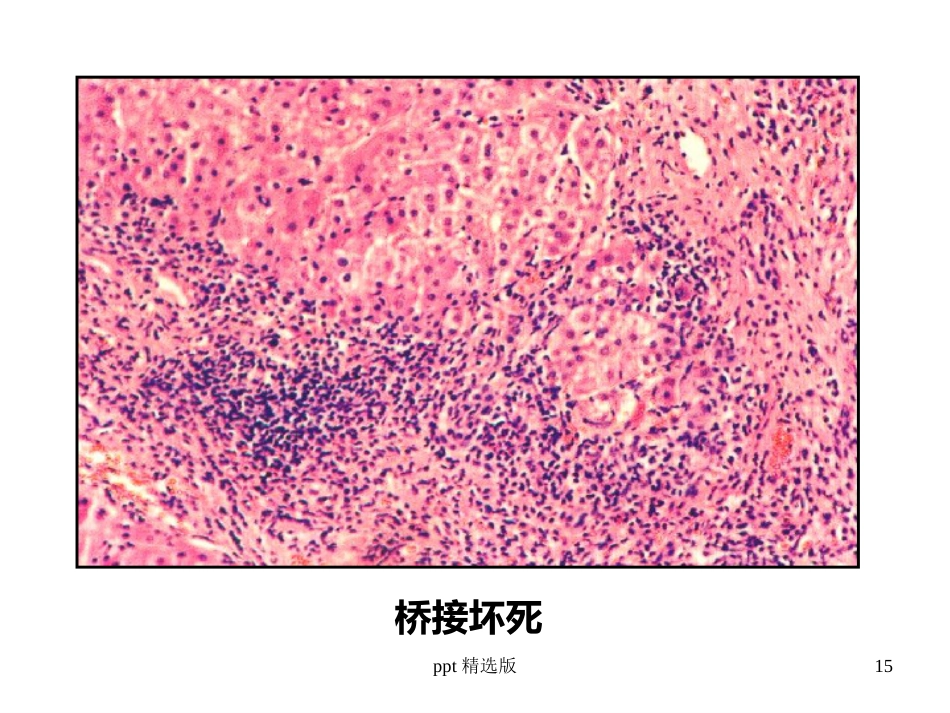病毒性肝炎,肝硬化,肝癌ppt课件_第15页