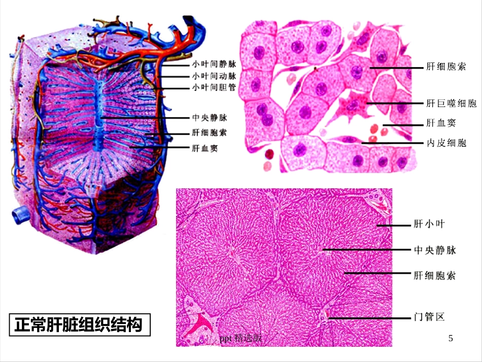 病毒性肝炎,肝硬化,肝癌ppt课件_第5页