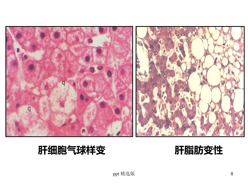 病毒性肝炎,肝硬化,肝癌ppt课件_第8页