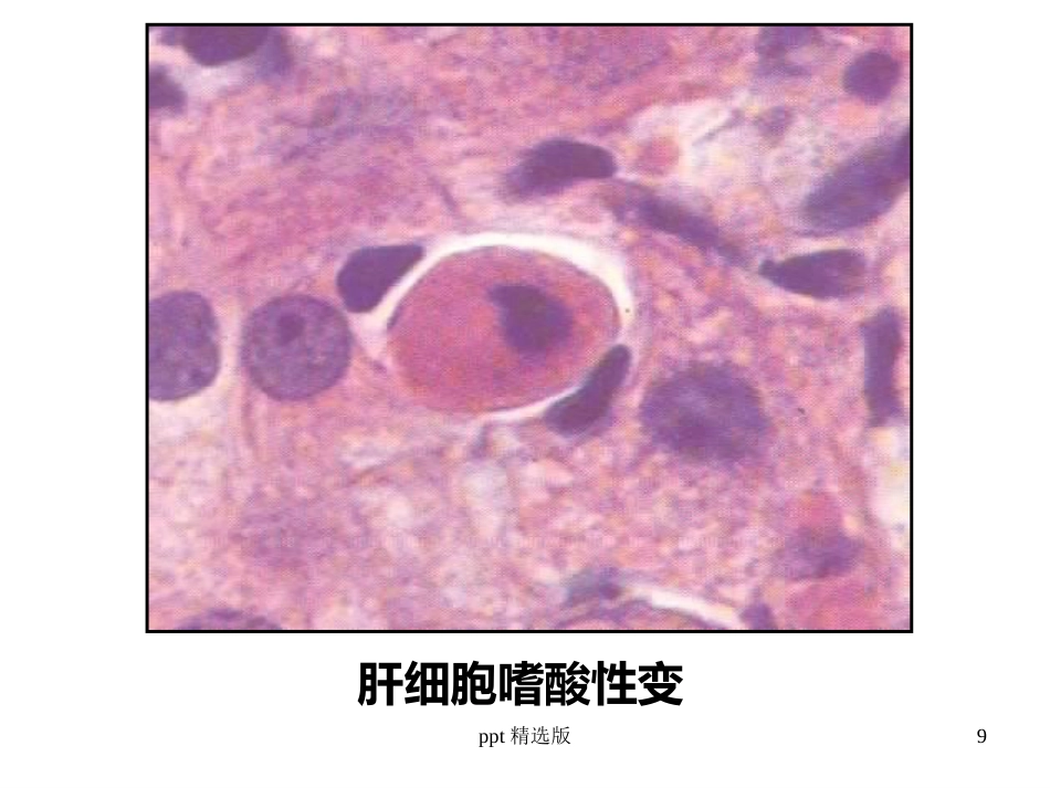 病毒性肝炎,肝硬化,肝癌ppt课件_第9页
