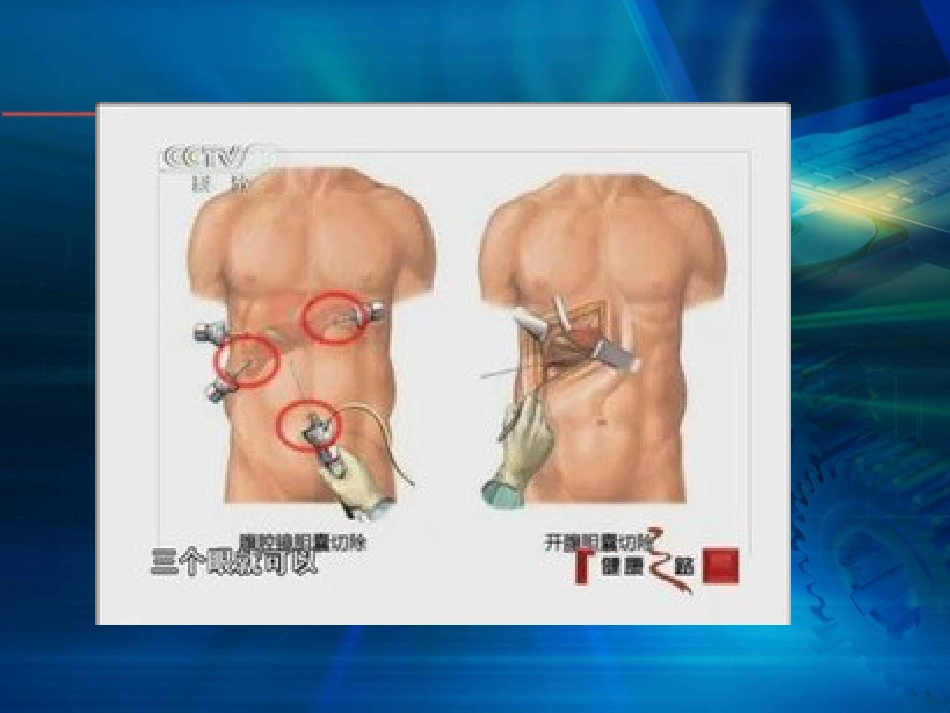 腹腔镜在肝胆胰外科应用进展(1)_第9页