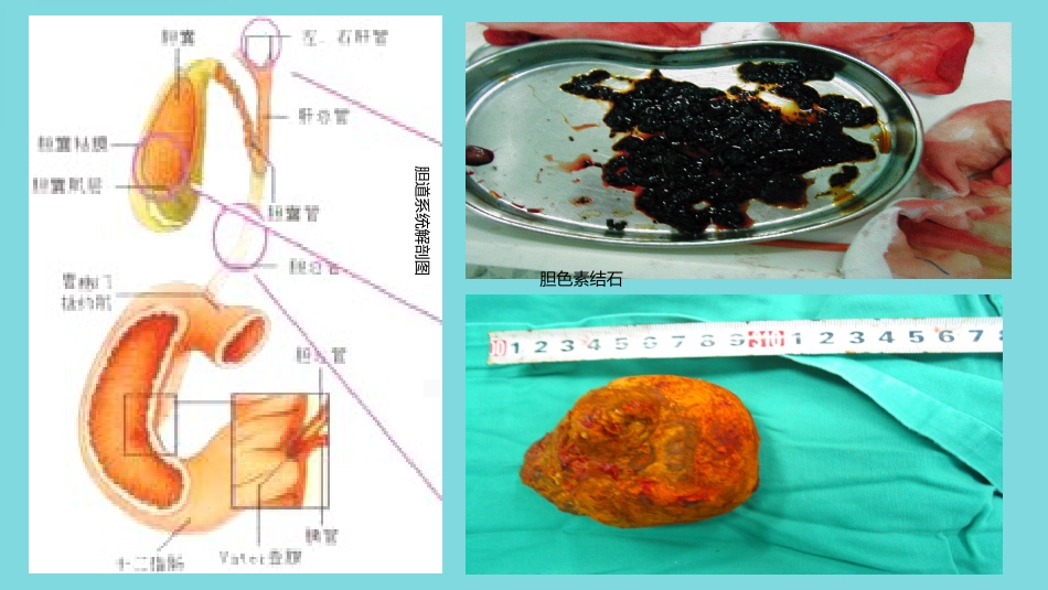 胆管结石(1)_第4页