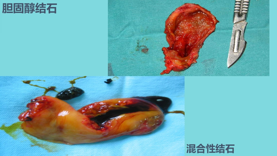 胆管结石(1)_第5页