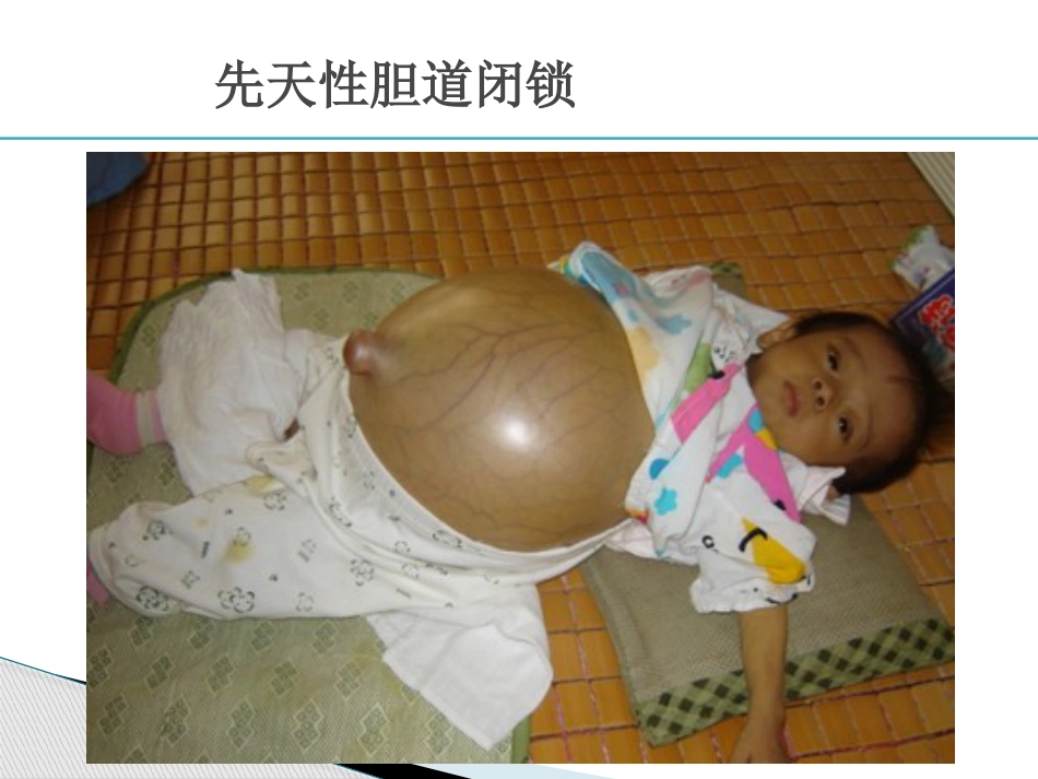 胆道疾病(6)_第15页