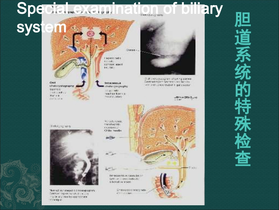 胆道疾病(9)_第15页