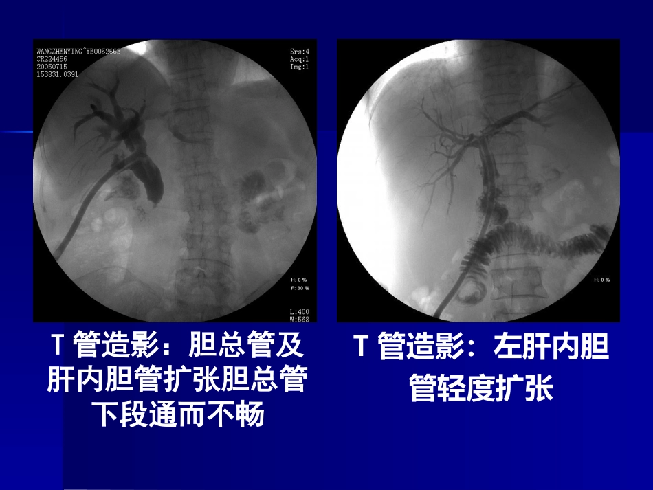 胆道疾病(11)_第13页