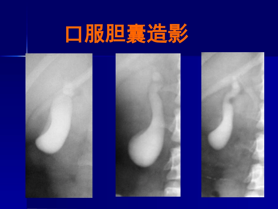 胆道疾病(11)_第14页