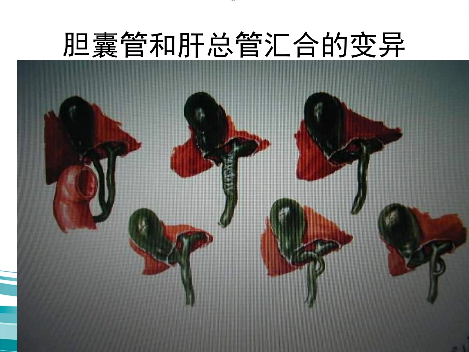 胆道疾病(12)_第15页