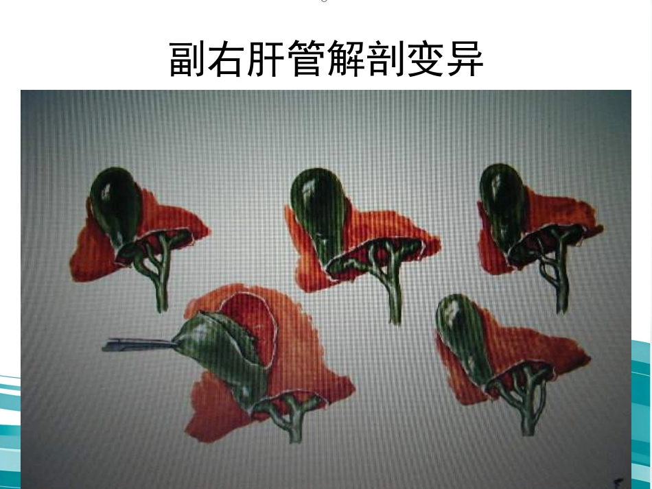 胆道疾病(12)_第8页