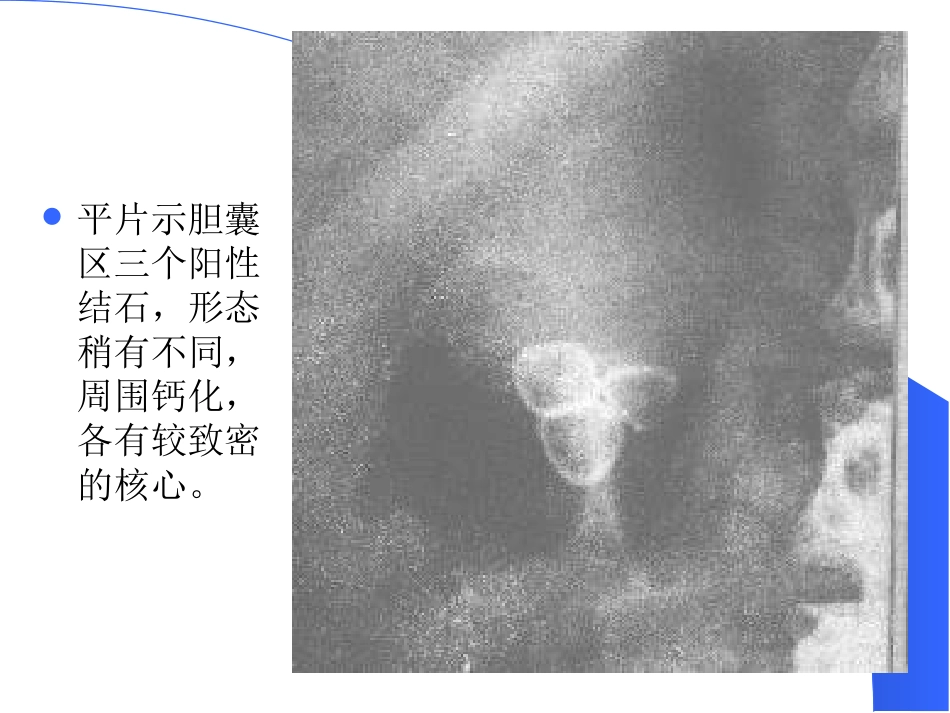 胆道疾病(13)_第15页