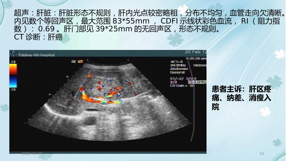 2020年肝癌的超声诊断及鉴别诊断_第11页