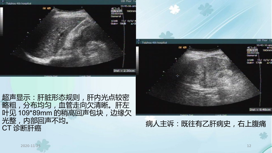 2020年肝癌的超声诊断及鉴别诊断_第12页