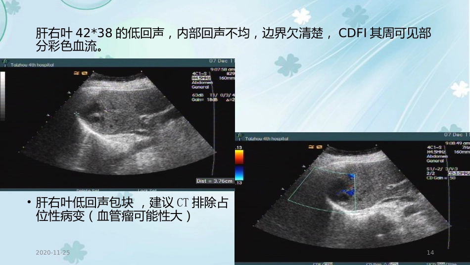 2020年肝癌的超声诊断及鉴别诊断_第14页