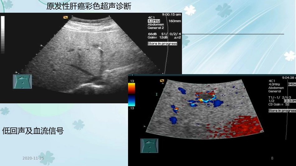 2020年肝癌的超声诊断及鉴别诊断_第8页