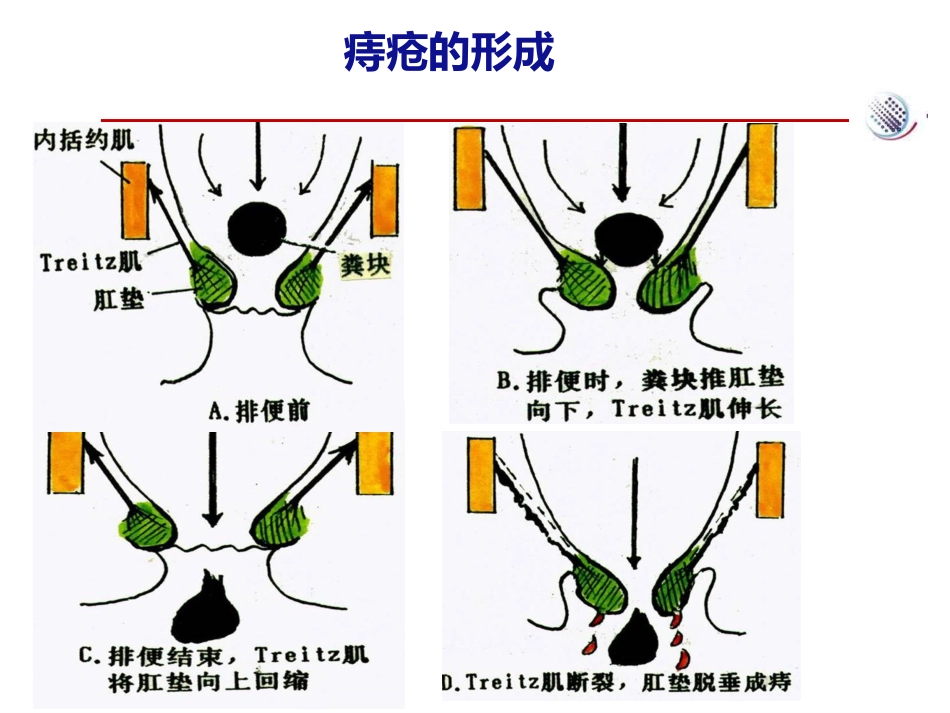 爱脉朗痔疮防治新选择-整合篇_第7页
