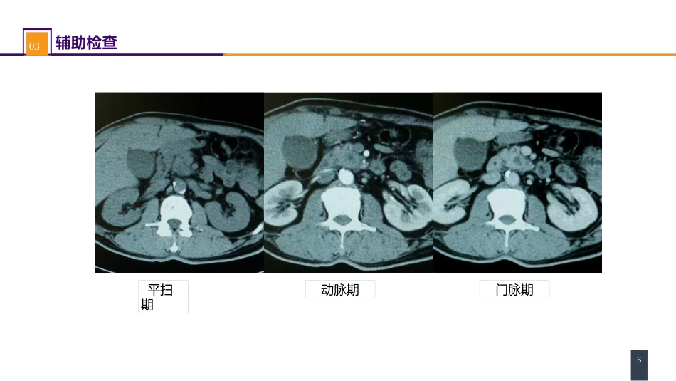 胰腺疾病 案例分析-胰腺癌_第6页